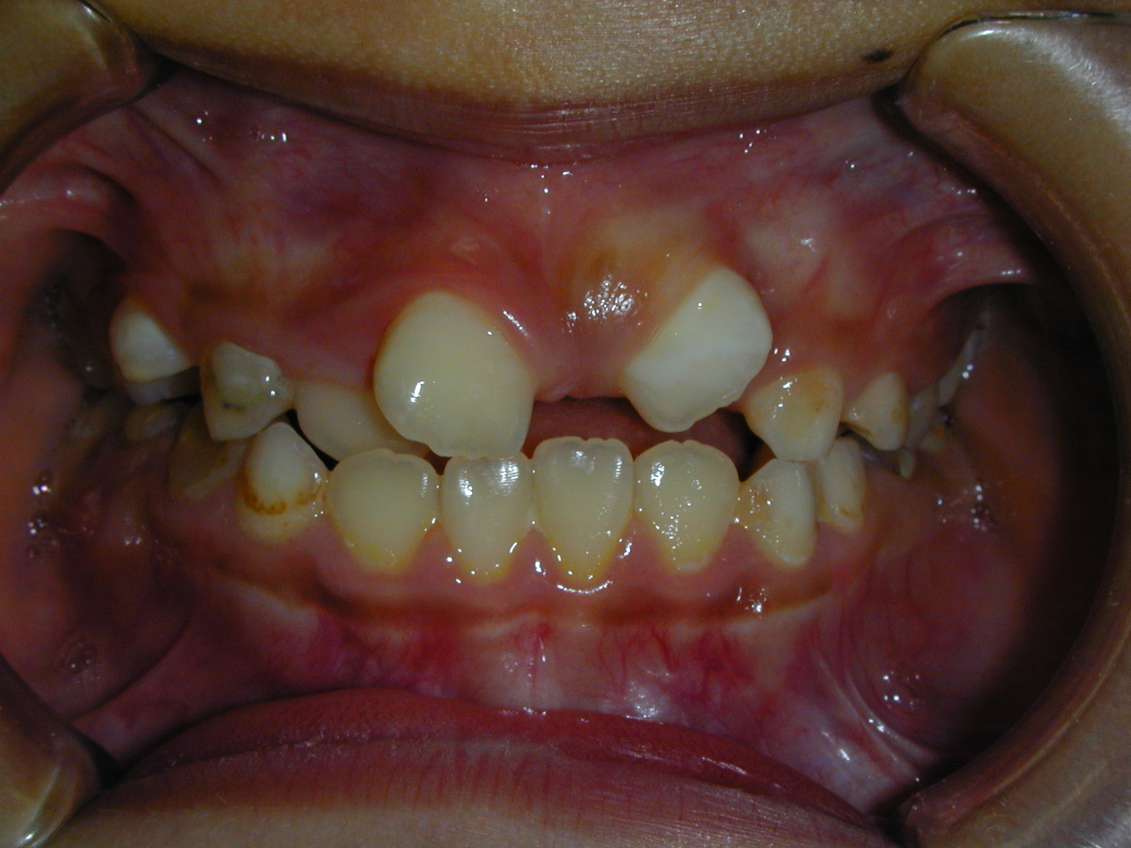 過剰歯３